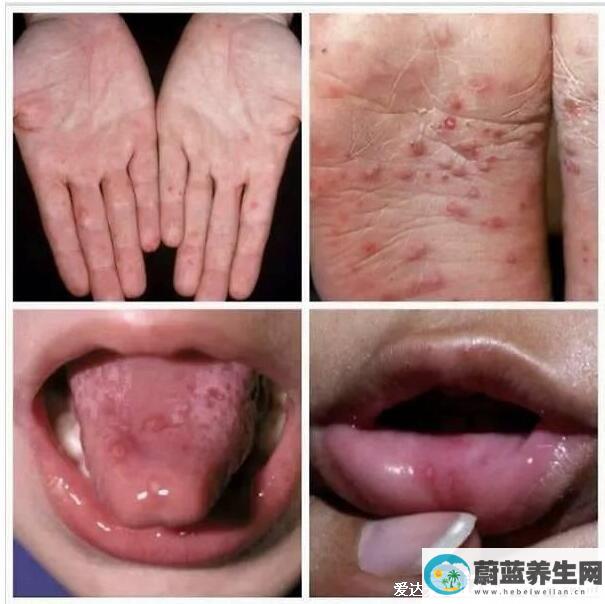 人体100种皮肤病对照图症状及名称，皮肤病种类及对应图片大片