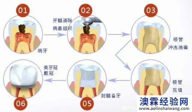 根管治疗后悔一辈子